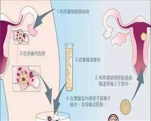 上海代生取卵麻醉方式详解：费用与安全指南